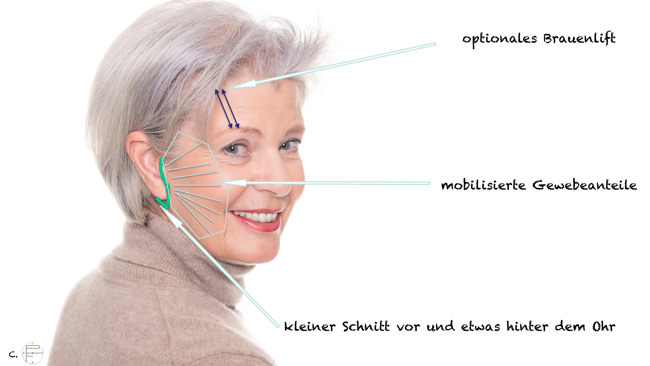 Minilift (MACS-Facelift = Minimal Access Cranial Suspension)