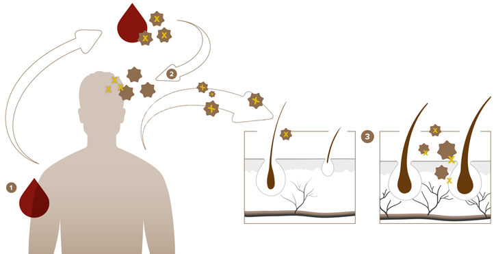 Eigenblutplasma-Therapie bei Haarausfall