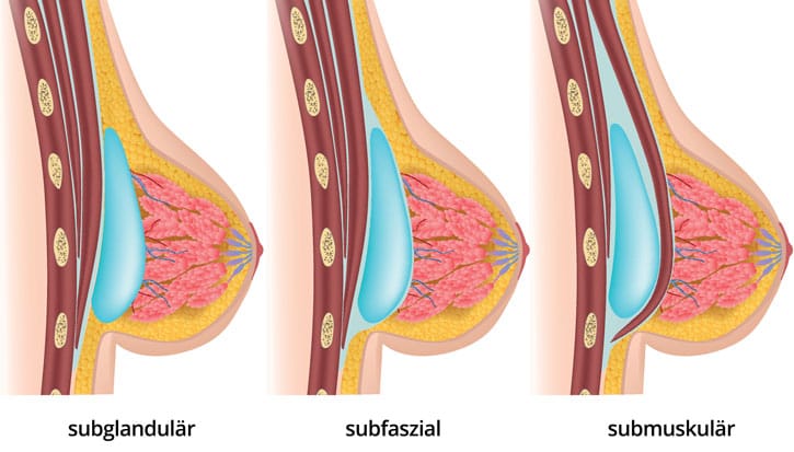 Brustvergrößerung mittels transplantiertem Eigenfettgewebe