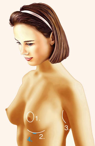 Brustvergrößerung mittels transplantiertem Eigenfettgewebe