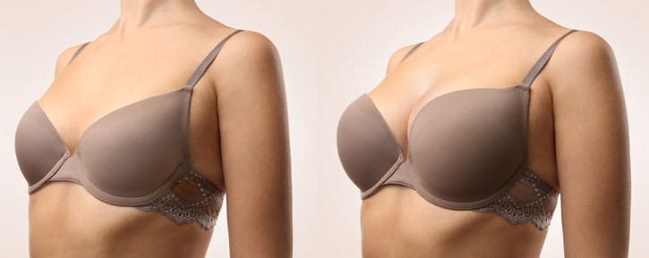 vorher / nachher – Brustvergrößerung