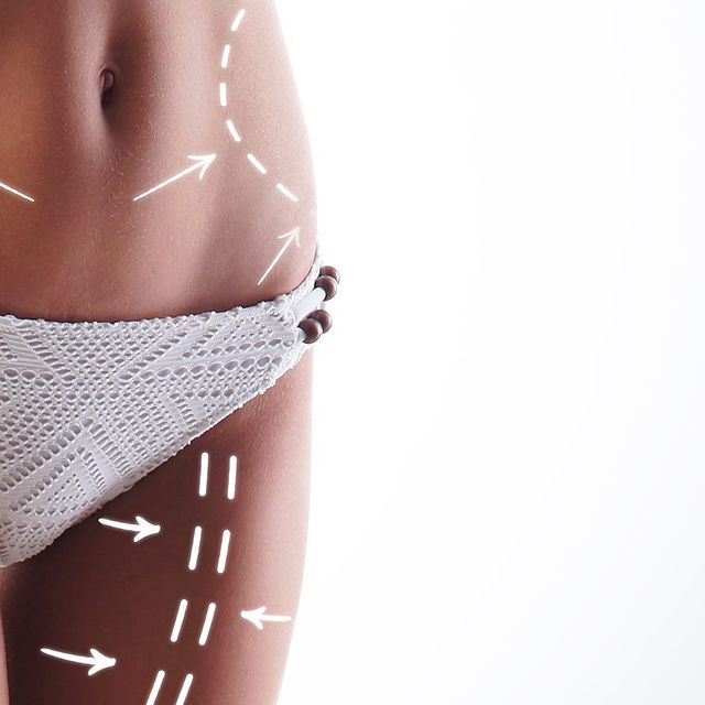 Ambulante Fettabsaugung