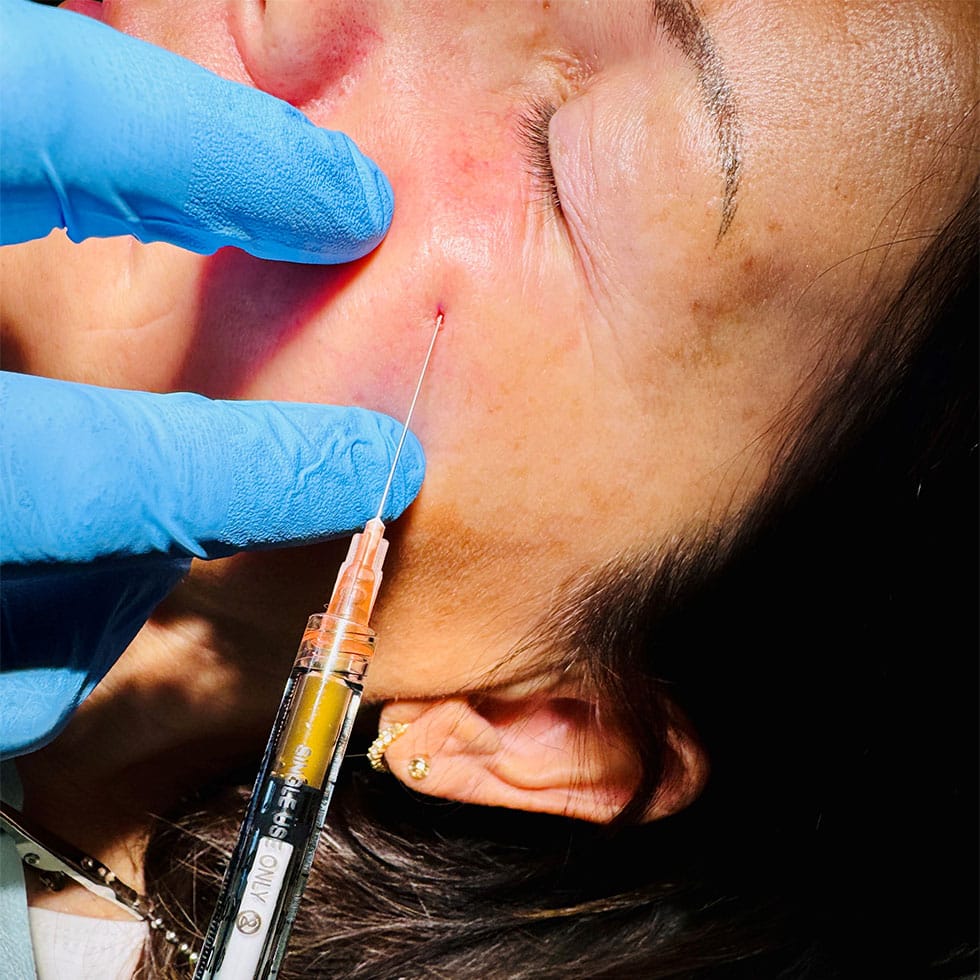 PRF / körpereigenes Plasmagel Anwendung PRF / körpereigenes Plasmagel Anwendung