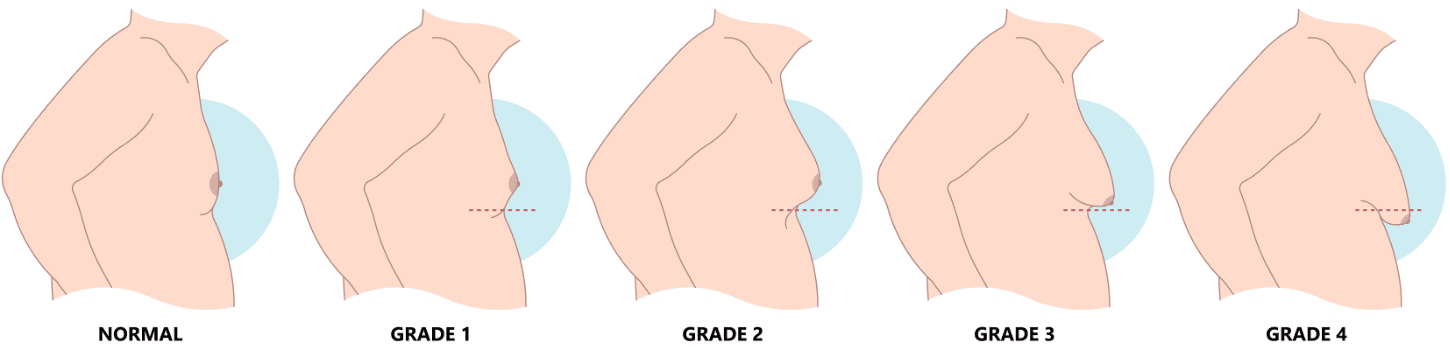Gynäkomastie /Männerbrust Grade nach Tanner Gynäkomastie /Männerbrust Grade nach Tanner