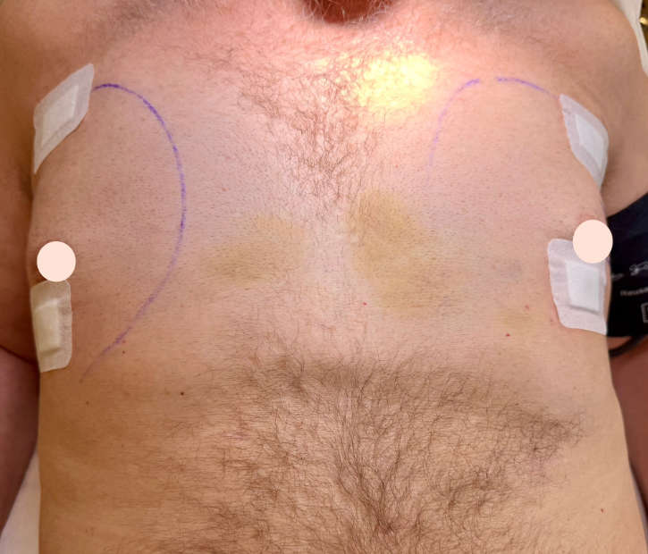 Gynäkomastie / Männerbrust nachher Gynäkomastie / Männerbrust nachher