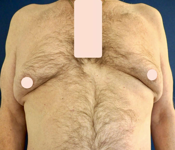 Gynäkomastie / Männerbrust vorher Gynäkomastie / Männerbrust vorher