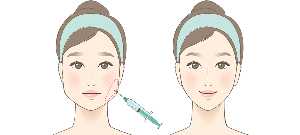 „Facial Slimming“ als Zusatznutzen der Masseter Botox-Therapie